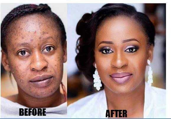 Permanent Skin Bleaching And Whitening Products In Queanbeyan City in Australia, Plettenberg Bay And Beaufort West Call ✆ +27710732372 Stretch Marks Removal And Breast Lifting In Rustenburg, Louis Trichardt South Africa And Gobleg Town In Bali, Indonesia