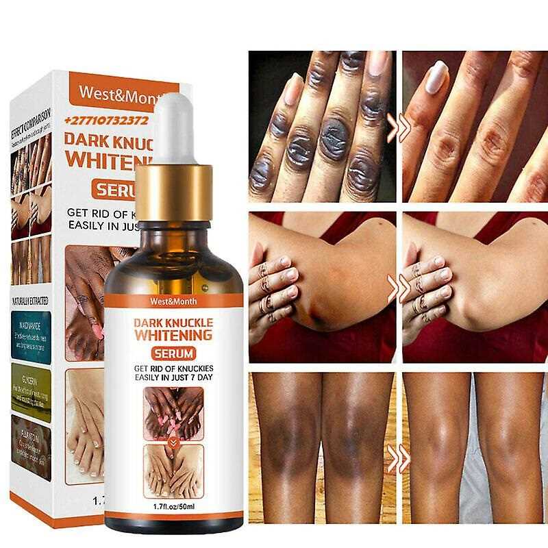 Dark Knuckle Whitening Serum Hand Elbow Knee Brightening Serum In Nisshin City in Japan, Nigel And Saldanha Town Call +2771 073 2372 Get Rid Scars And Stretch Marks In Johannesburg South Africa And Chínipas de Almada Town in Mexico